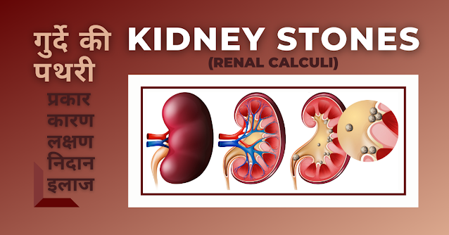 KIDNEY STONES (RENAL CALCULI)