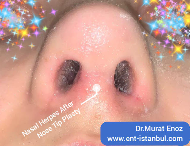 Nasal Herpes,herpes simplex virus infection before the rhinoplasty,HSV,