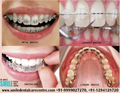 Best Dental Clinic for Orthodontist and invisible Aligner Braces in Faridabad