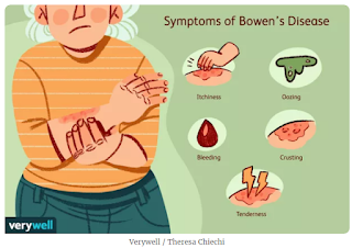 Bowens Disease - Symptoms and Treatment you should know