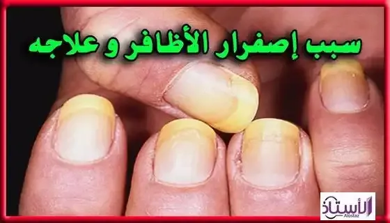 Treat-yellowing-nails-with-this-simple-recipe