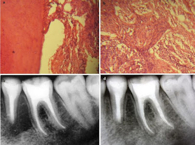 Image Radicular cyst and Histopathology