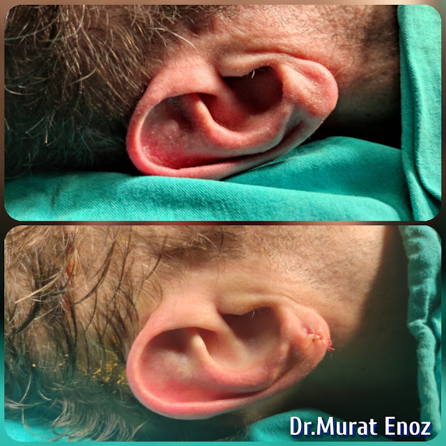 Ear Lobe Reduction