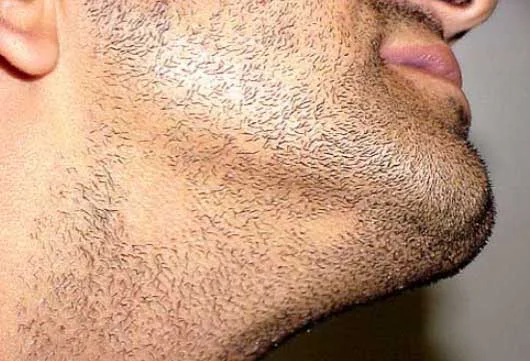 الثعلبة أسفل الرقبة