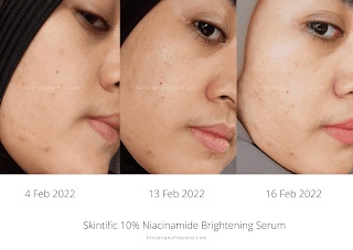 before-after-Skintific-10%-Niacinamide-Brightening-Serum-bintangmahayana-com