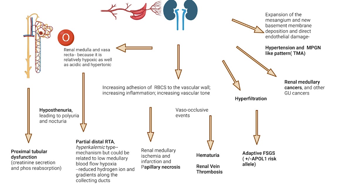 Nephron Power Concept Map Sickle Cell And The Kidney