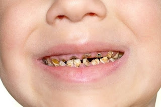 Tham khảo thông tin răng hàm có thay không từ nha khoa-1