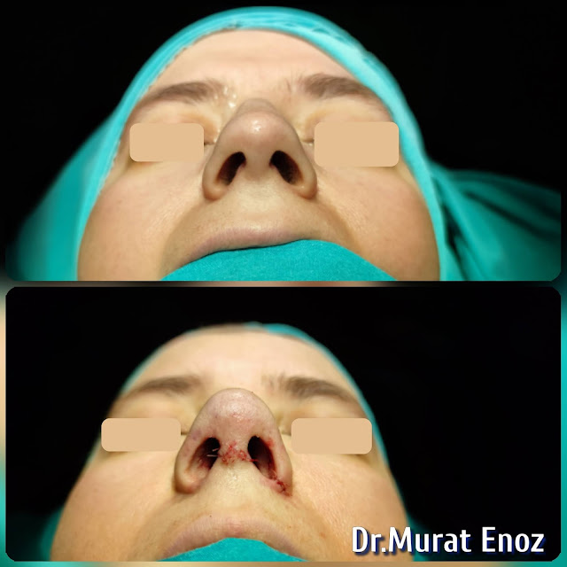 Natural nose aesthetic surgery for female,natural-looking rhinoplasty