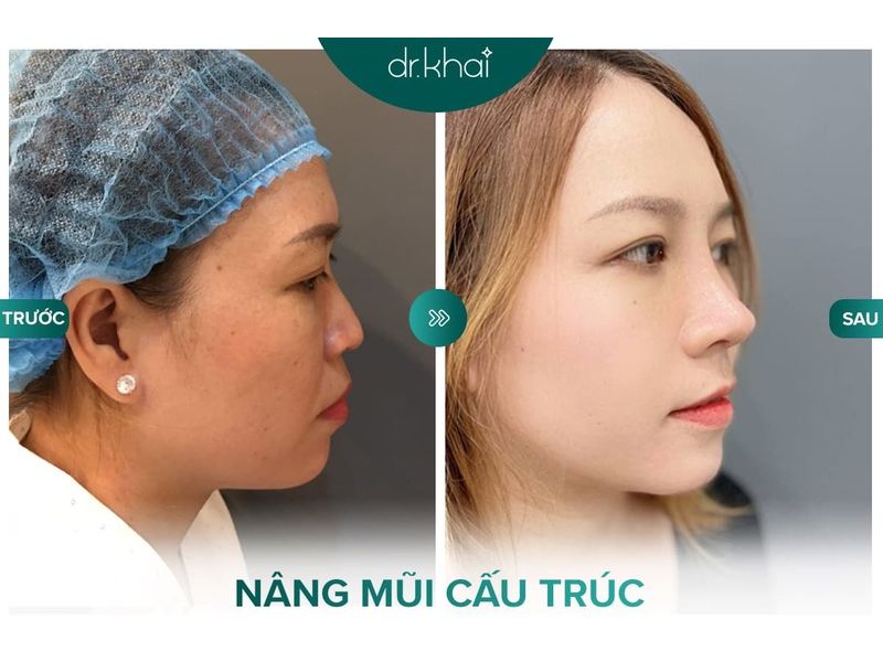 Sủa mũi S Line cao tây - Bác sĩ Khải