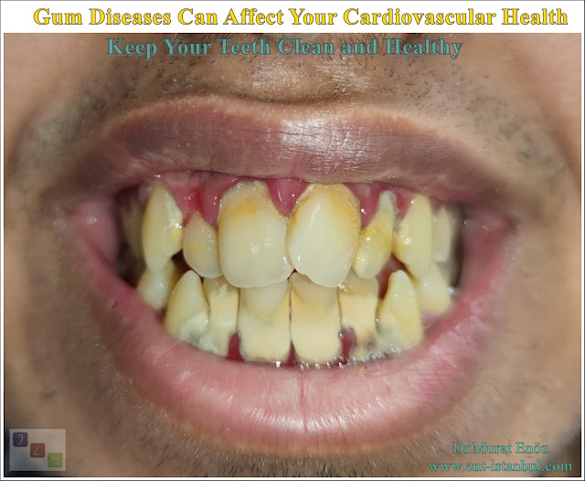 Cardiovascular Health,Gum Disease, Heart Disease, Coronary Artery Disease, Atherosclerosis ,