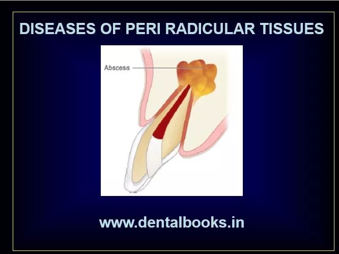 Diseases of Periradicular Tissues PPT and Notes For Final Exams