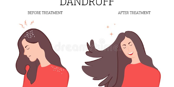 Easy Ways to Get Rid of Dandruff Naturally, Proven!