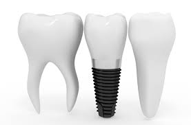 Cấy ghép răng implant là gì-2