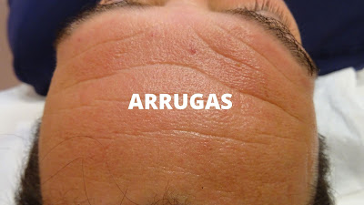 Arrugas