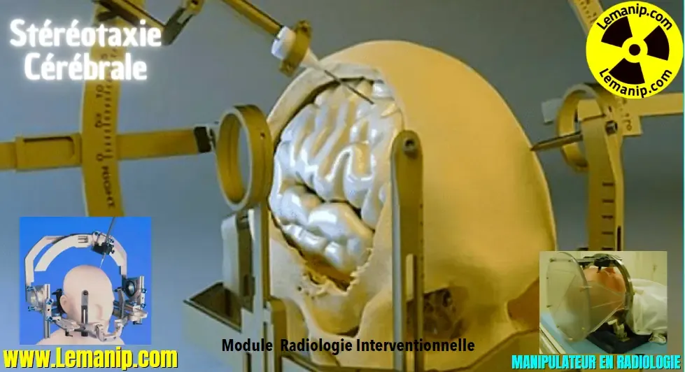 Une Stéréotaxie Cérébrale
