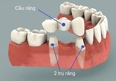 Trồng răng hàm giá bao nhiêu với cầu răng sứ? 2