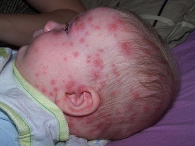 Một số hình ảnh bệnh thủy đậu ở trẻ nhỏ giai đoạn toàn phát