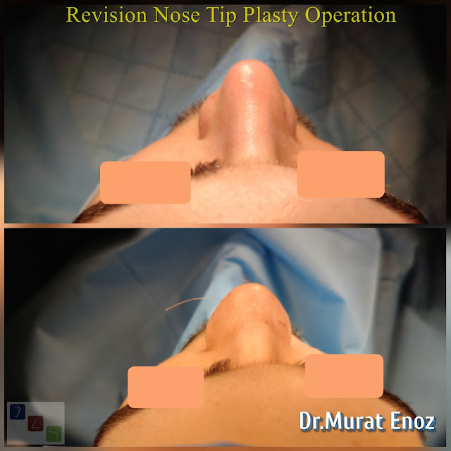 Revision Aesthetic Nose Tip Surgery,Revision Nose Tip Plasty in Istanbul,
