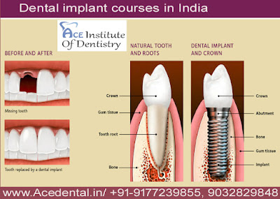 Dental Implant courses in India