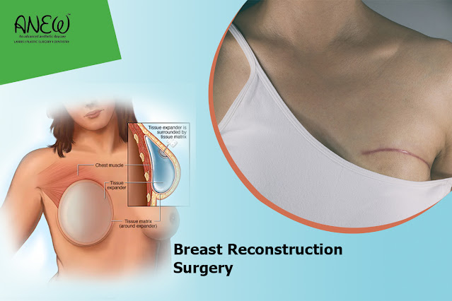 breast reconstruction surgery in Bangalore.