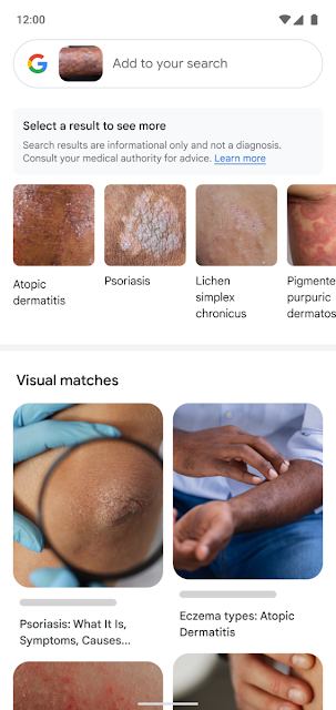 Google Lens Adds New Feature to Help Identify Skin Conditions