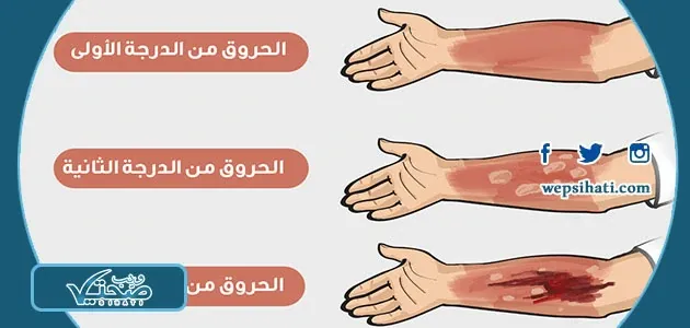 تعرف على أنواع الحروق بالصور وما هي أسبابها وطرق العلاج بشكل مناسب