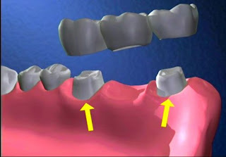 Phương pháp cầu răng sứ là gì-2