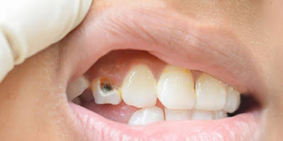 penyebab plak hitam gigi dan cara menghilangkan nya sehat mah harus