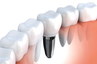 Giải pháp cấy ghép răng implant-2