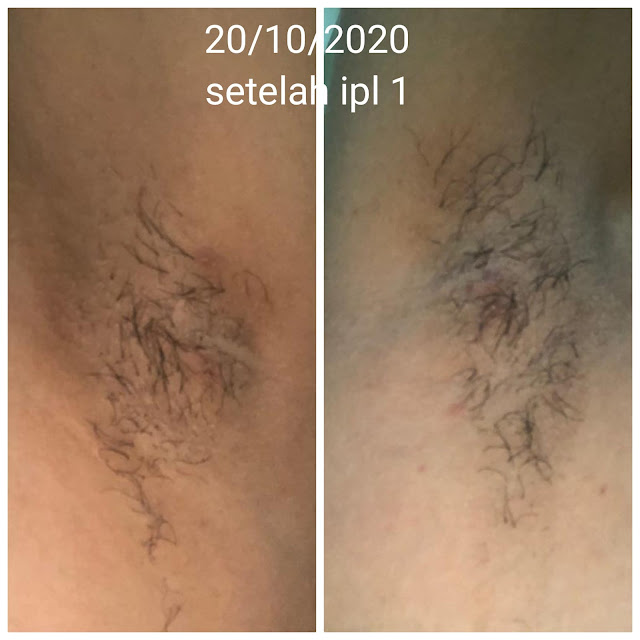 before_after_sebelum_sesudah_laser_ketiaK_underarm_IPL