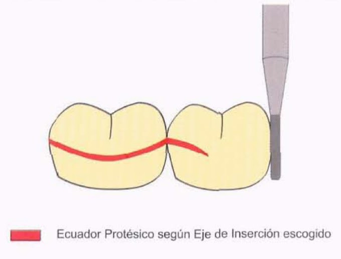 PDF: Ecuador Protésico o Eje de Inserción