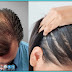 Understanding Hair Loss: A Guide to Male and Female Pattern Baldness
