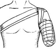 Наложение повязок на культи конечности