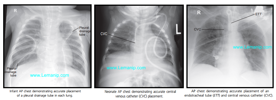 mesothelioma chest x ray,asthma chest x ray,asthma lungs x ray,mesothelioma x ray,cdh xray,asbestosis chest x ray,asbestos lung x ray,asbestosis x ray,hmi xray,asthma x ray