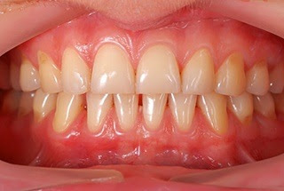 Periodontal therapies are products that are used to treat periodontitis.