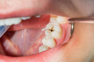 Carie dentaria: la causa