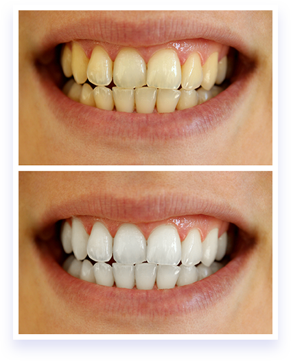 Natural Teeth Whitener