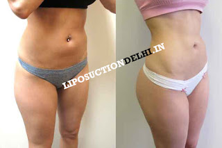 liposuction result