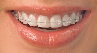 Quy trình niềng răng mắc cài sứ-1