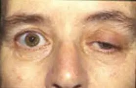 Meaning of myasthenia gravis. The face of a person with muscular weakness with a drooping eye