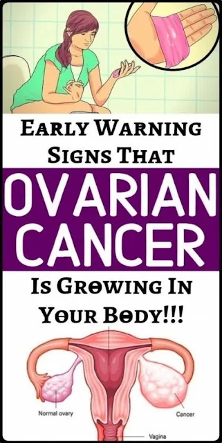 Attention Girls: These Are The First Two Symptoms Of Ovarian Cancer Doctors Often Misdiagnose