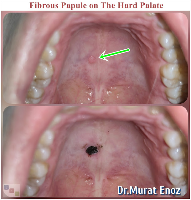 Fibrous Papule,angiofibromas, excisional biopsy of the hard palate,Papule fibreuse,