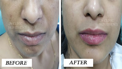 Manage Unwanted Pigmentation By the Best Dermatologist in Patel Nagar, Delhi