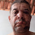 Radialista Cival Anjos se recupera em casa após sofrer acidente de bicicleta 