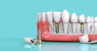 Trồng răng implant có tốt không-1