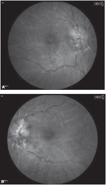 Fundus photographs from a patient