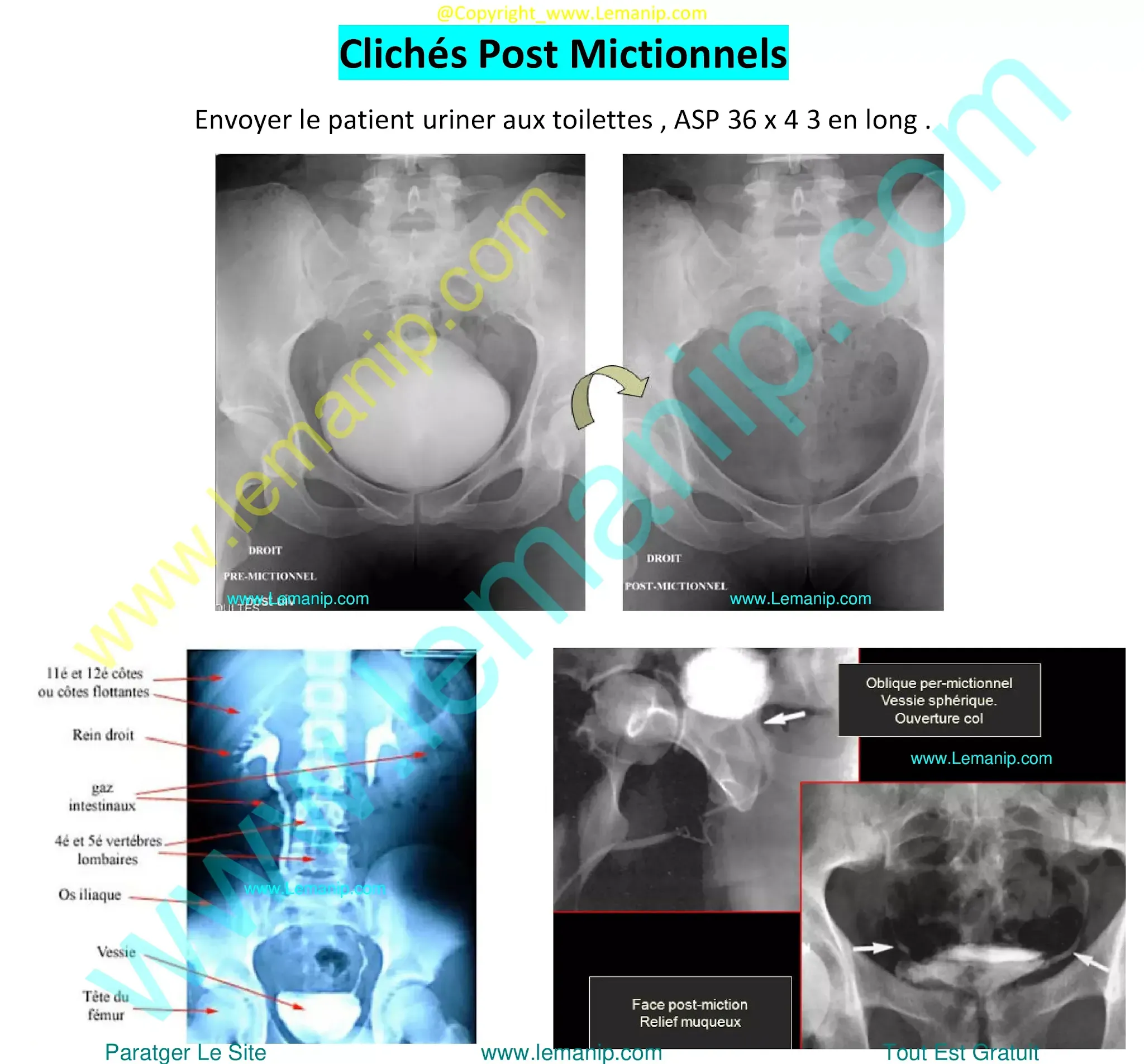 Clichés Post Mictionnels