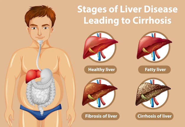 Understanding the Connection Between Liver Disease and Urine Color