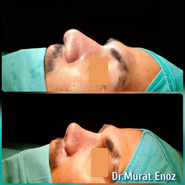 Natural nose aesthetic surgery for male,Male thick skinned rhinoplasty,Ethnic expert rhinoplasty surgeon,Ethnic Rhinoplasty in Istanbul,