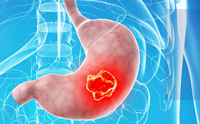 Cómo afecta tus hábitos alimenticios al cáncer digestivo